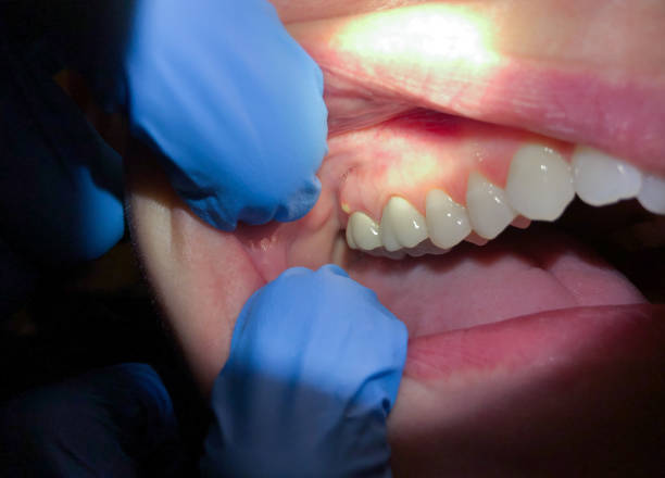 Best Broken or Cracked Tooth Emergency Dentist in West Pasco, WA